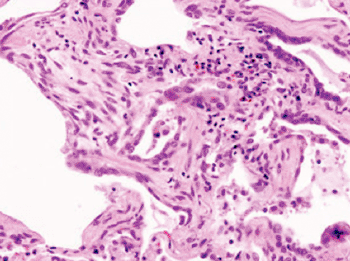Image: Histopathology of idiopathic pulmonary fibrosis (Photo courtesy of the American Thoracic Society).